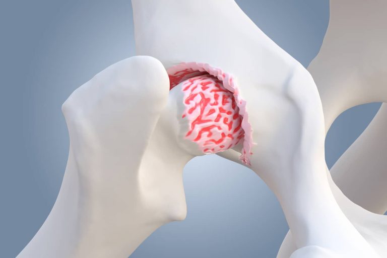 hip dysplasia in dogs